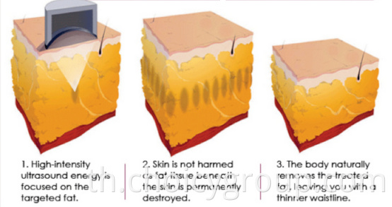 Liposunic Working theory